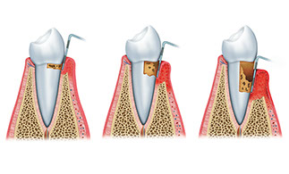 Zahnarztpraxis Dr. Isabel Selmair - München, Schwabing / Parodontitisbehandlung