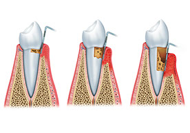 Zahnarztpraxis Dr. Isabel Selmair - München, Schwabing / Parodontitisbehandlung