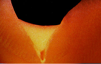 Zahnarztpraxis Dr. Isabel Selmair - München, Schwabing / Vorsorge (Prophylaxe), Fissuren und Versiegelungen