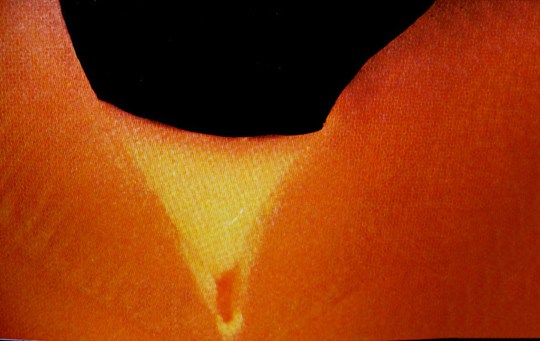 Zahnarztpraxis Dr. Isabel Selmair - München, Schwabing / Vorsorge (Prophylaxe), Fissuren und Versiegelungen