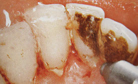 Zahnarztpraxis Dr. Isabel Selmair - München, Schwabing / Vorsorge (Prophylaxe), Professionelle Zahnreinigung