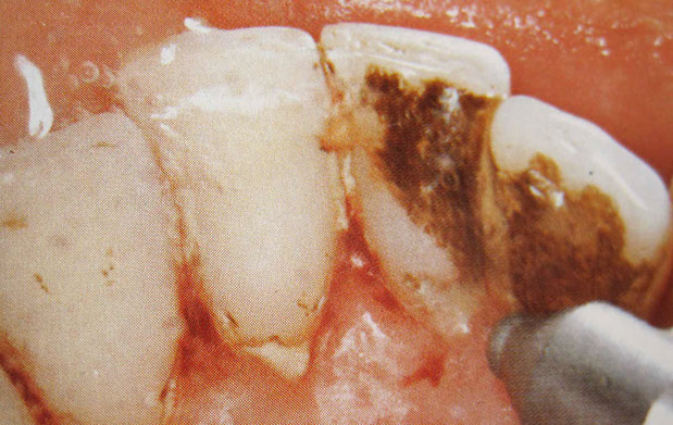 Zahnarztpraxis Dr. Isabel Selmair - München, Schwabing / Vorsorge (Prophylaxe), Professionelle Zahnreinigung